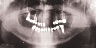 Before and after Bone Graft photos by Dr. 