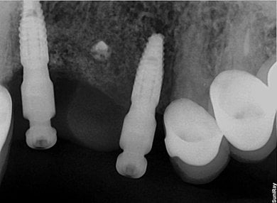Результат кісткової регенерації з імплантами в SoftDentalCare Clinic, рентген після процедури
