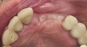 Before and after Bone Graft photos by Dr. 