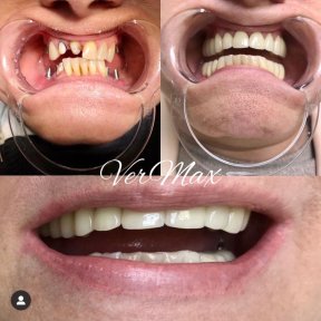 Vorher-nachher-Ergebnis Zahnimplantate und Hollywood Smile bei VerMax Dental Clinic
