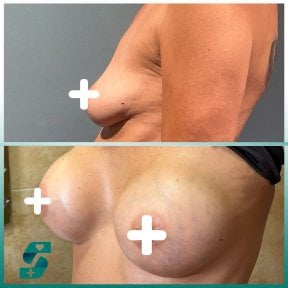 Résultats avant/après augmentation mammaire chez Soraca Med – volume des seins accru