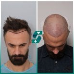 Fotos vor und nach Haartransplantation bei Frauen durch Dr. 