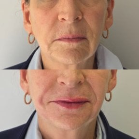 Resultados antes y después de rellenos en Dr. Lavalle's Private Practice, rejuvenecimiento facial