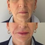 Resultados antes y después de rellenos en Dr. Lavalle's Private Practice, rejuvenecimiento facial