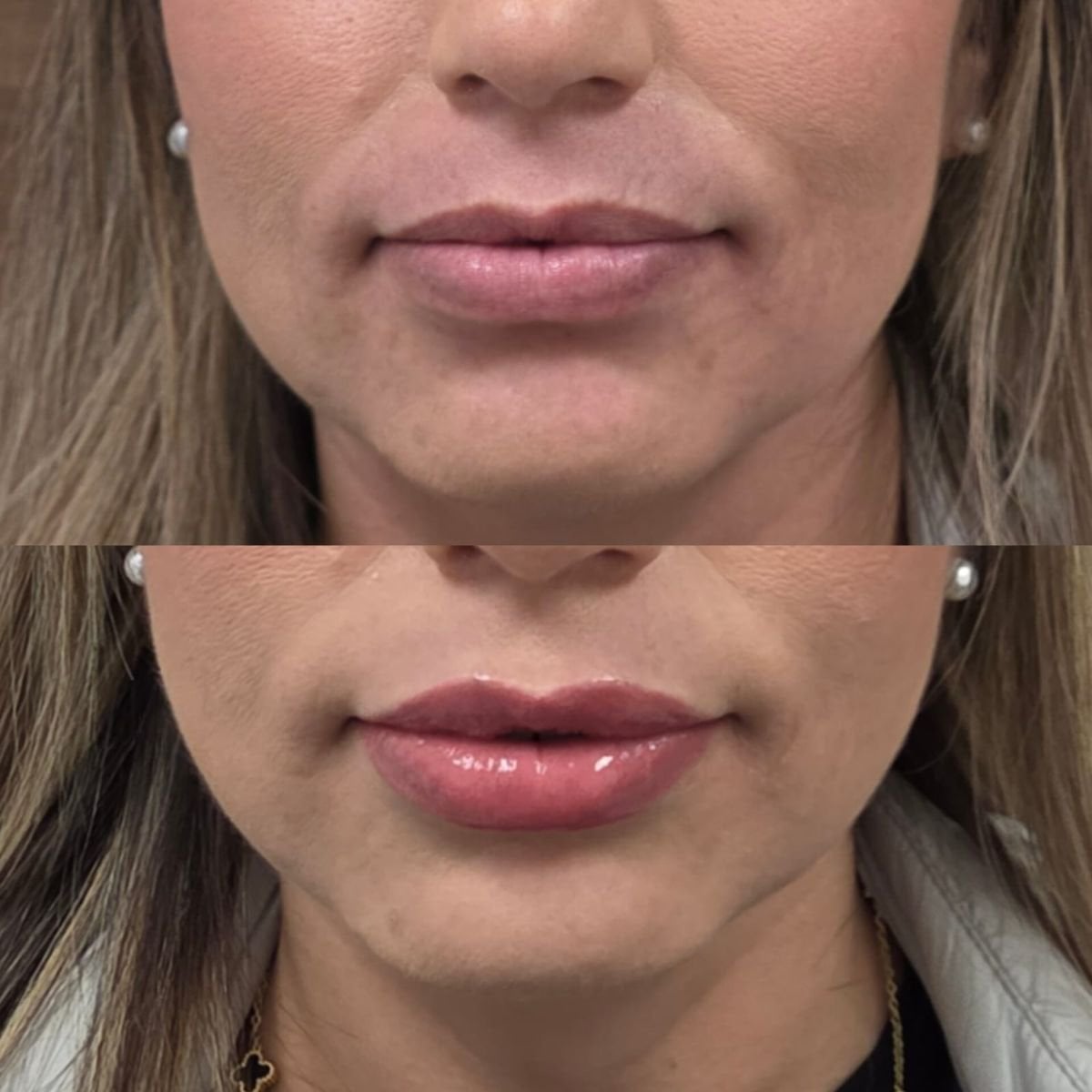 Before and after lip fillers injection at Dr. Lavalle's Private Practice, enhanced lip volume result