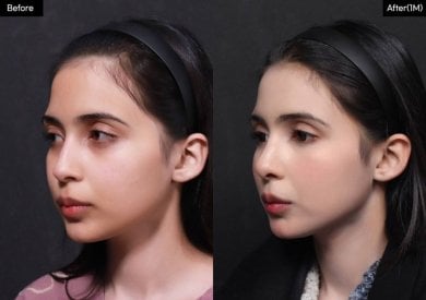 Результат до и после открытой ринопластики в VG Plastic Surgery, улучшена форма носа