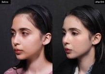 Результат до и после открытой ринопластики в VG Plastic Surgery, улучшена форма носа