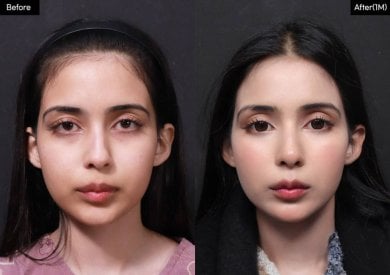 Результат до и после открытой ринопластики в VG Plastic Surgery, естественная коррекция носа