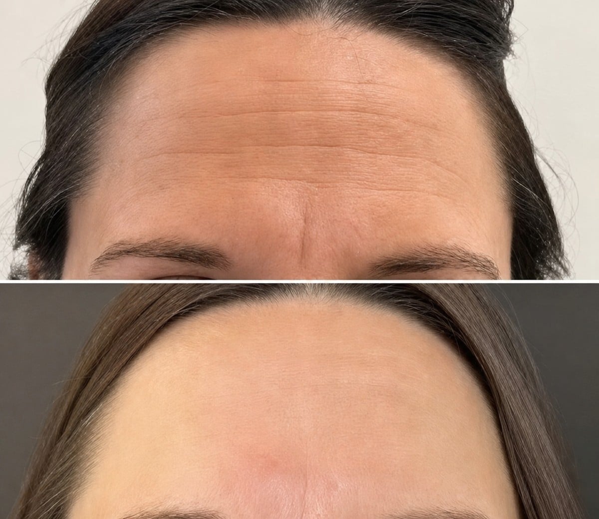 Antes y después de inyecciones de botox en Dr. Alexandro Aguilera - Plastic Surgery, frente lisa