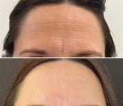 Before and after Botox injections at Dr. Alexandro Aguilera - Plastic Surgery, smoother forehead result