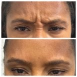 Before and after Botox injections at Dr. Alexandro Aguilera - Plastic Surgery, smoother forehead result