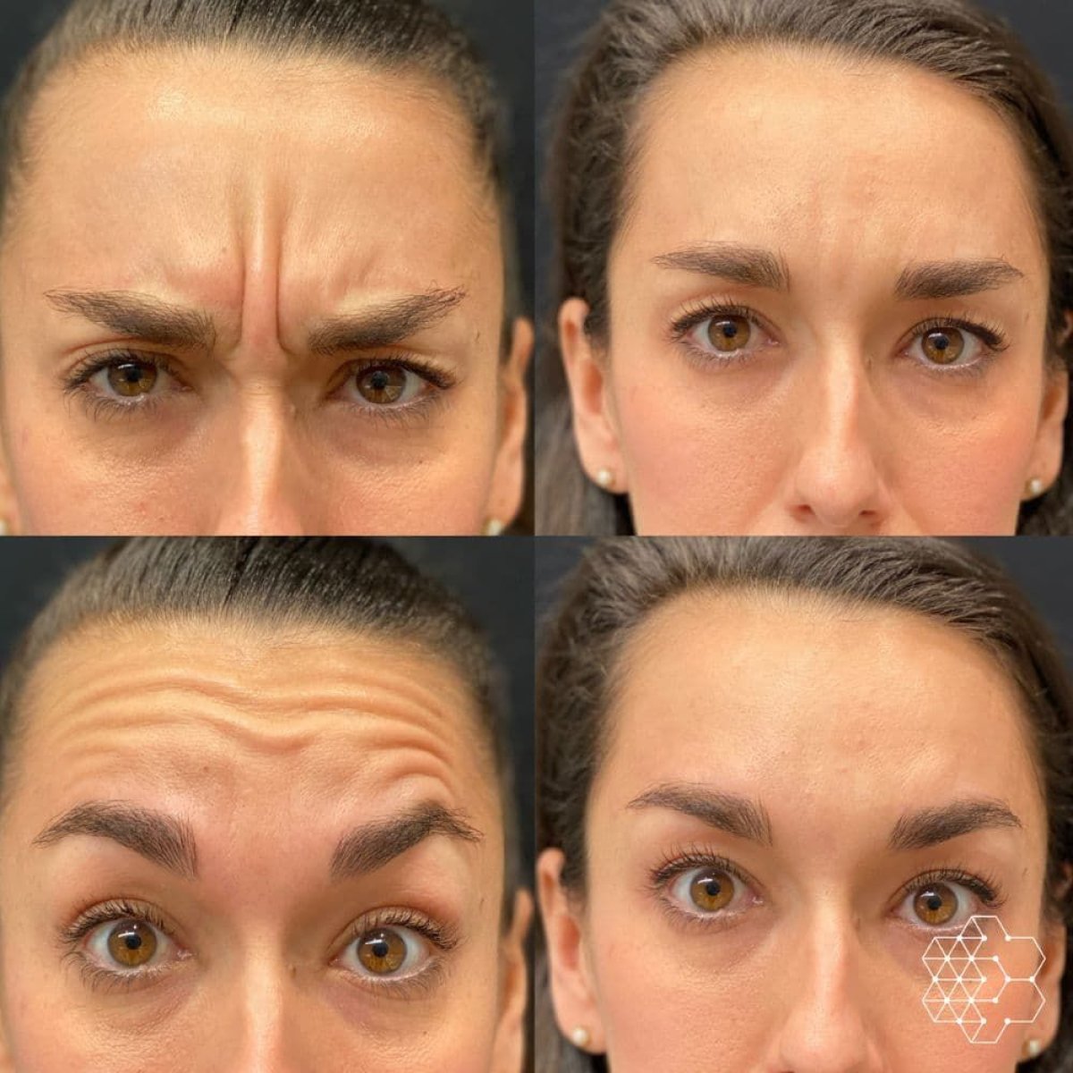 Antes y después de inyecciones de bótox en Dr. Alexandro Aguilera - Plastic Surgery, reducción de arrugas en la frente