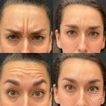 Before and after Botox injections at Dr. Alexandro Aguilera - Plastic Surgery, forehead wrinkle reduction