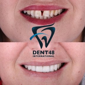 Vorher-nachher-Ergebnis Sofortprothesen bei Dent48 Oral and Dental Health Polyclinics