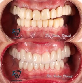 Vorher-nachher-Ergebnis Sofortprothesen bei Dent48 Oral and Dental Health Polyclinics