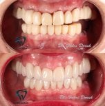 Vorher-nachher-Ergebnis Sofortprothesen bei Dent48 Oral and Dental Health Polyclinics