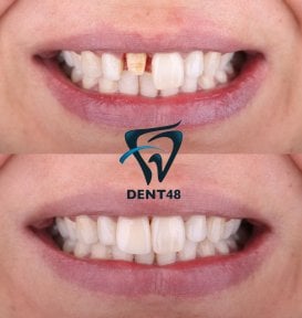 Vorher-nachher-Ergebnis Sofortprothesen bei Dent48 Oral and Dental Health Polyclinics