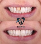 Vorher-nachher-Ergebnis Sofortprothesen bei Dent48 Oral and Dental Health Polyclinics