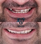 Vorher-nachher-Ergebnis der Sofortprothesen bei Dent48 Oral and Dental Health Polyclinics