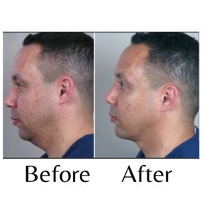 Before and after double chin liposuction results at ID Clinic Bangkok, improved jawline contour