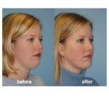 Before and after double chin liposuction results at ID Clinic Bangkok, improved jawline contour