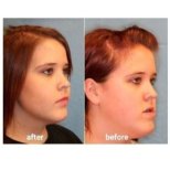 Before and after double chin liposuction results at ID Clinic Bangkok, improved jawline contour