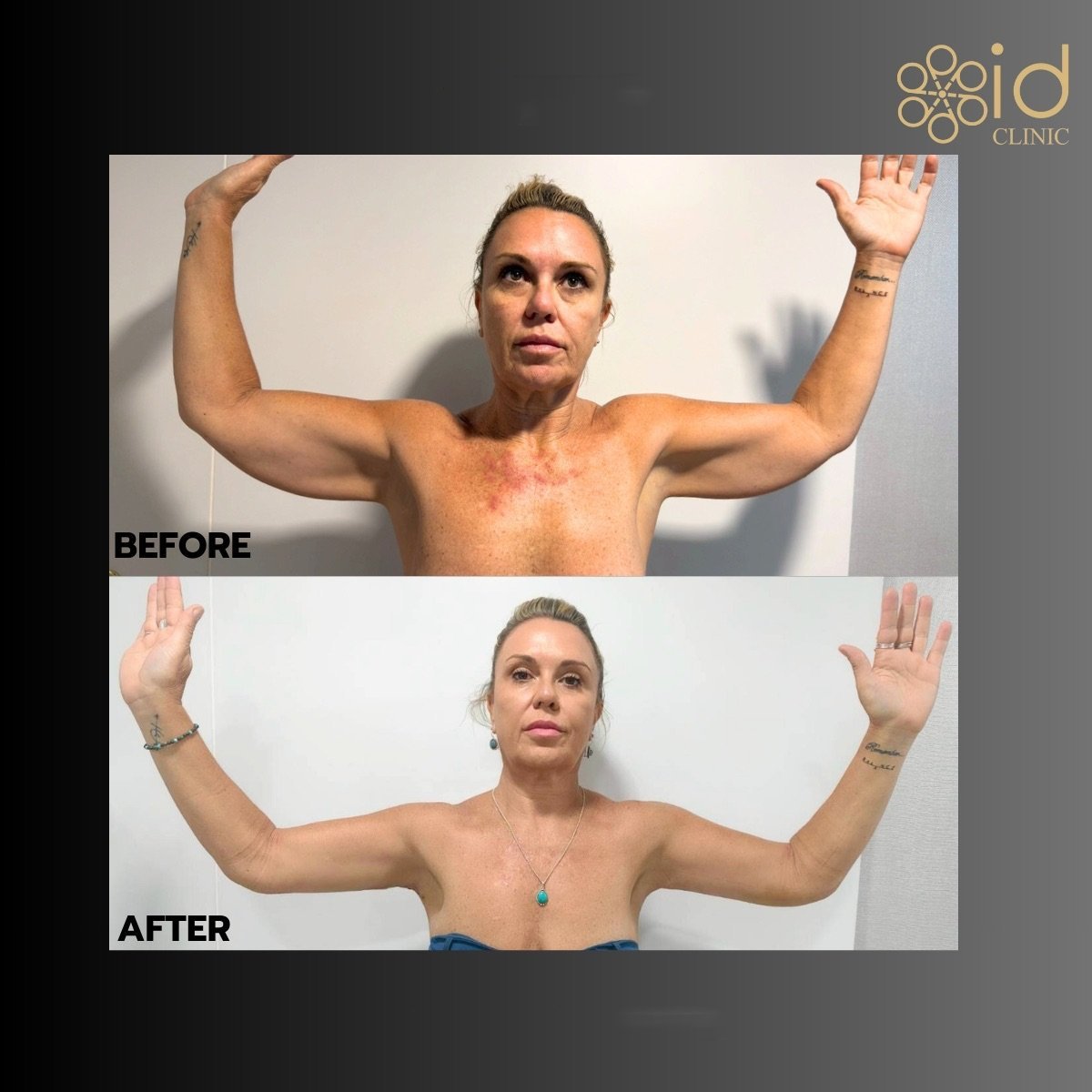 Resultados de lifting de brazos (braquioplastia) antes y después en ID Clinic Bangkok