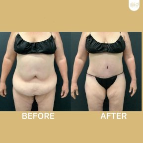 Before and after tummy tuck and liposuction results at ID Clinic Bangkok, flatter abdomen