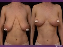 Before and after breast lift results at Vidnova Clinic – improved breast shape and contour