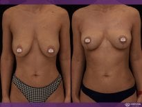 Before and after breast lift results at Vidnova Clinic – improved breast shape and contour