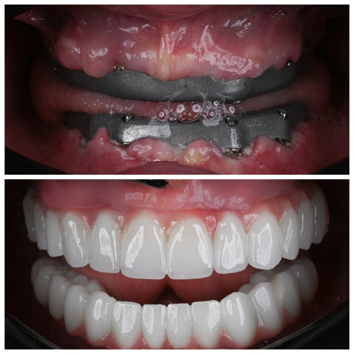 Resultado antes y después de implantes dentales All-on-4 de zirconia en Soraca Med, restauración total
