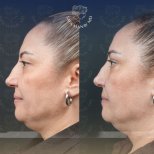 Vorher-nachher-Ergebnisse der Blepharoplastik in der Dr. Safa Manav Klinik, Lidkorrektur