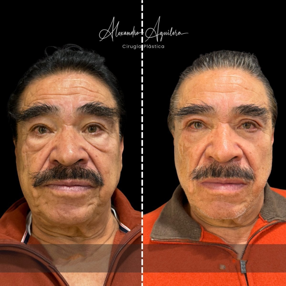 نتائج رأب الجفن السفلي قبل وبعد في عيادة Dr. Alexandro Aguilera لجراحة التجميل