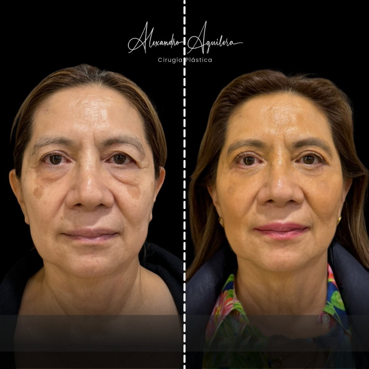 Before and after lower eyelid blepharoplasty results at Dr. Alexandro Aguilera - Plastic Surgery