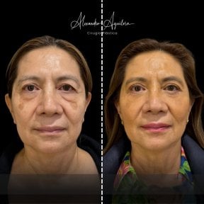 Vorher-nachher-Ergebnis Unterlid-Blepharoplastik bei Dr. Alexandro Aguilera - Plastische Chirurgie