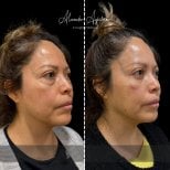 Vorher-nachher-Ergebnis der Unterlid-Blepharoplastik bei Dr. Alexandro Aguilera