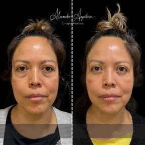Vorher-nachher-Ergebnis Unterlid-Blepharoplastik bei Dr. Alexandro Aguilera - Plastische Chirurgie
