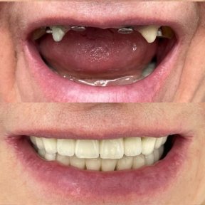 Vorher-nachher-Ergebnis Zahnimplantate bei VerMax Dental Clinic zur vollständigen Zahnsanierung