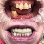 Результаты до и после имплантации зубов в VerMax Dental Clinic – восстановленная улыбка