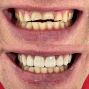 Vorher-nachher-Ergebnis Hollywood Smile bei VerMax Dental Clinic – verbesserte Zahnästhetik