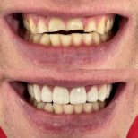 Vorher-nachher-Ergebnis Hollywood Smile bei VerMax Dental Clinic – verbesserte Zahnästhetik