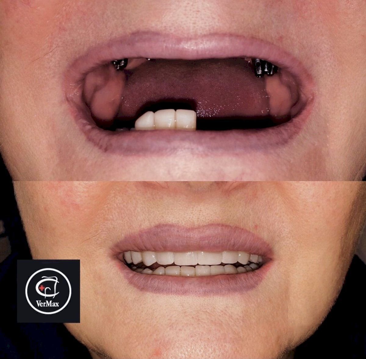 قبل وبعد زراعة الأسنان مع التاج في عيادة VerMax Dental Clinic، نتيجة ابتسامة مستعادة