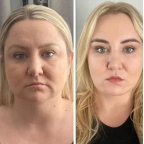 Before and after deep plane facelift results at Memorial Ataşehir Hospital, facial rejuvenation