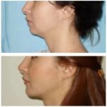 Before and after deep plane facelift results at Memorial Ataşehir Hospital, improved jawline