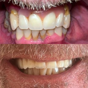 Before and after All-on-6 dental implants at Clínica Dental Raíces, smile restoration result