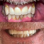 Before and after dental implant results at Clínica Dental Raíces, improved smile and teeth