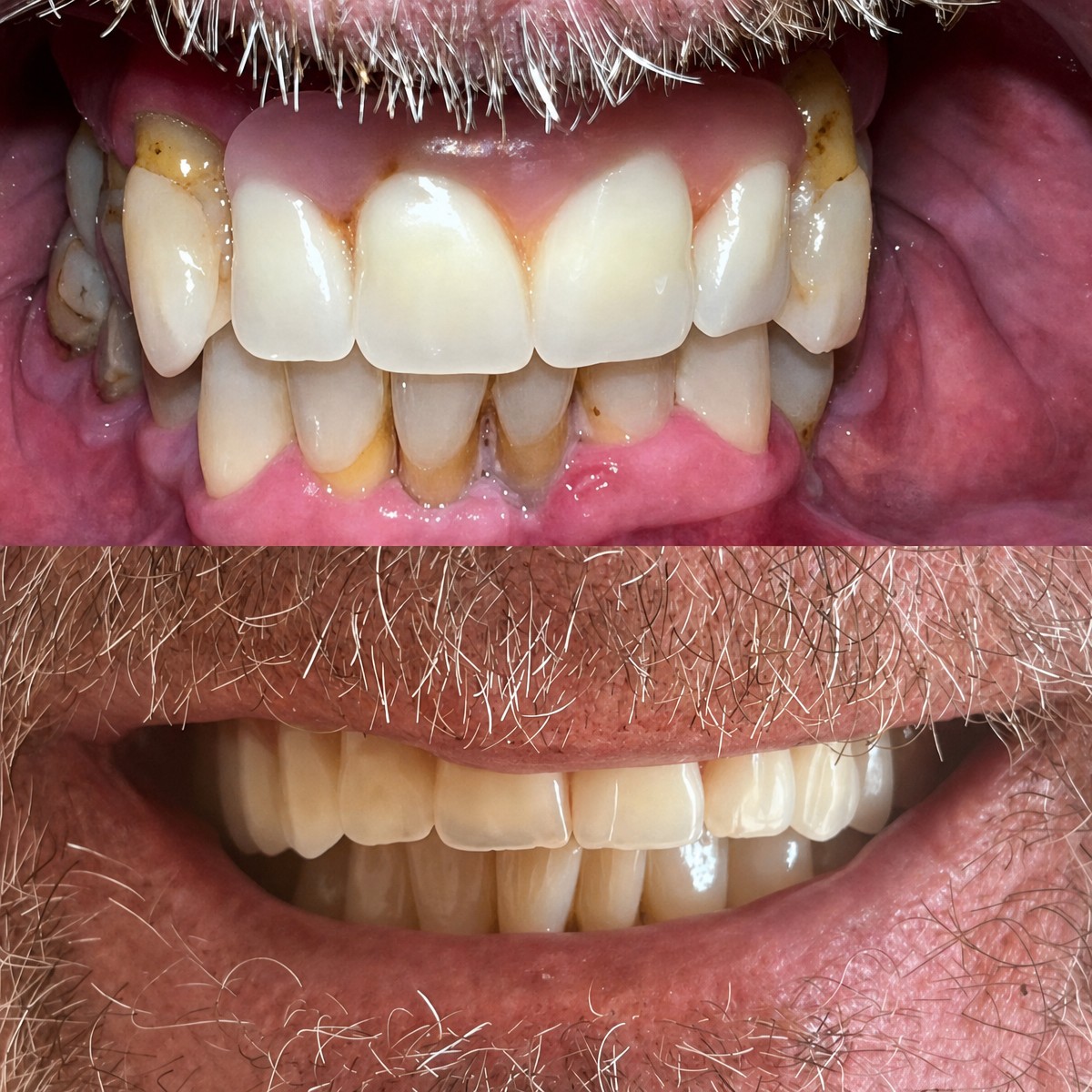 Resultado antes y después de implantes All-on-4 en Clínica Dental Raíces, sonrisa mejorada