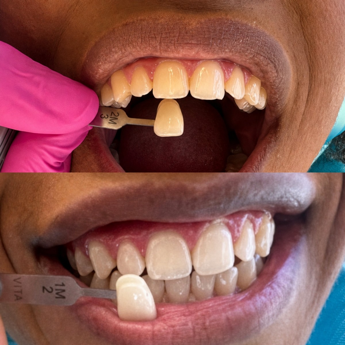نتائج تبييض الأسنان قبل وبعد في Clínica Dental Raíces، ابتسامة أكثر إشراقًا