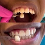 Vorher-nachher-Ergebnis Zahnaufhellung bei Clínica Dental Raíces, sichtbar helleres Lächeln