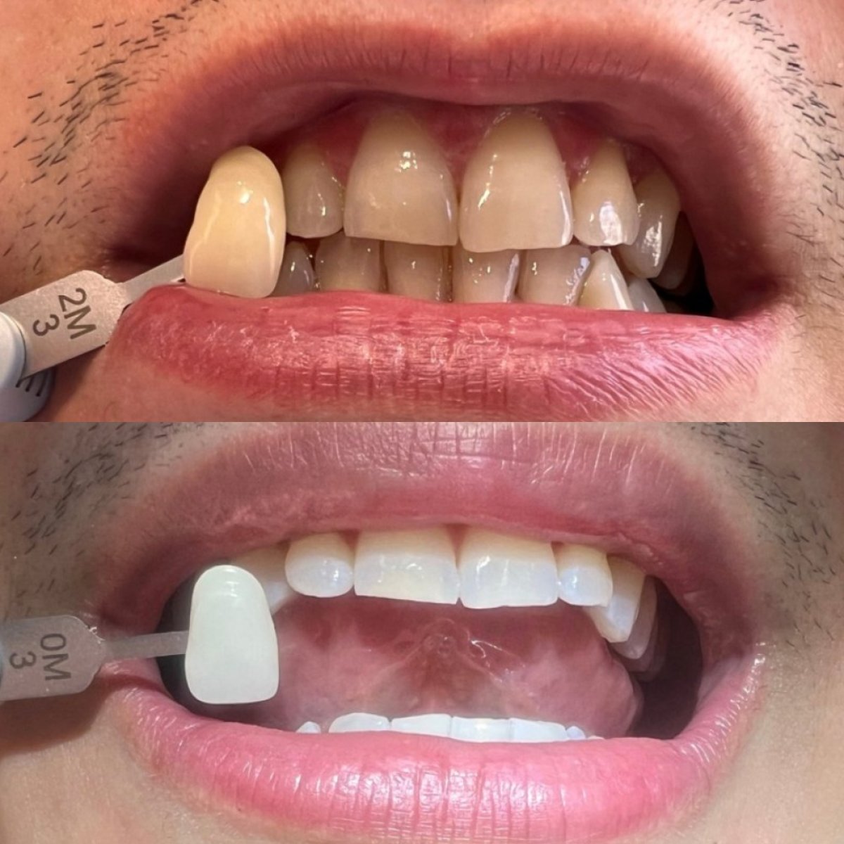 نتائج تبييض الأسنان قبل وبعد في Clínica Dental Raíces، ابتسامة أكثر إشراقًا